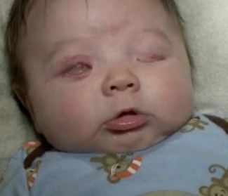 Richie 3 mesi, è nato senza occhi, ma i suoi genitori lo amano tanto!