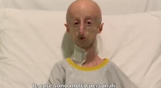 sammy_basso_progeria